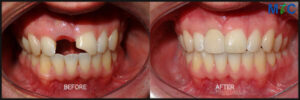 Dental Crowns Before and After