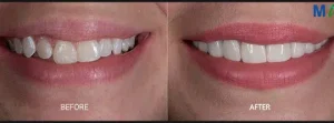 Dental Veneers – Before and After