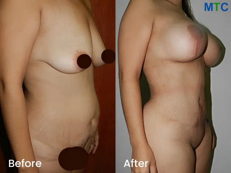 Dr.-Rafael-Velasco-Marin-Breast-lift-testimonials-4.jpg
