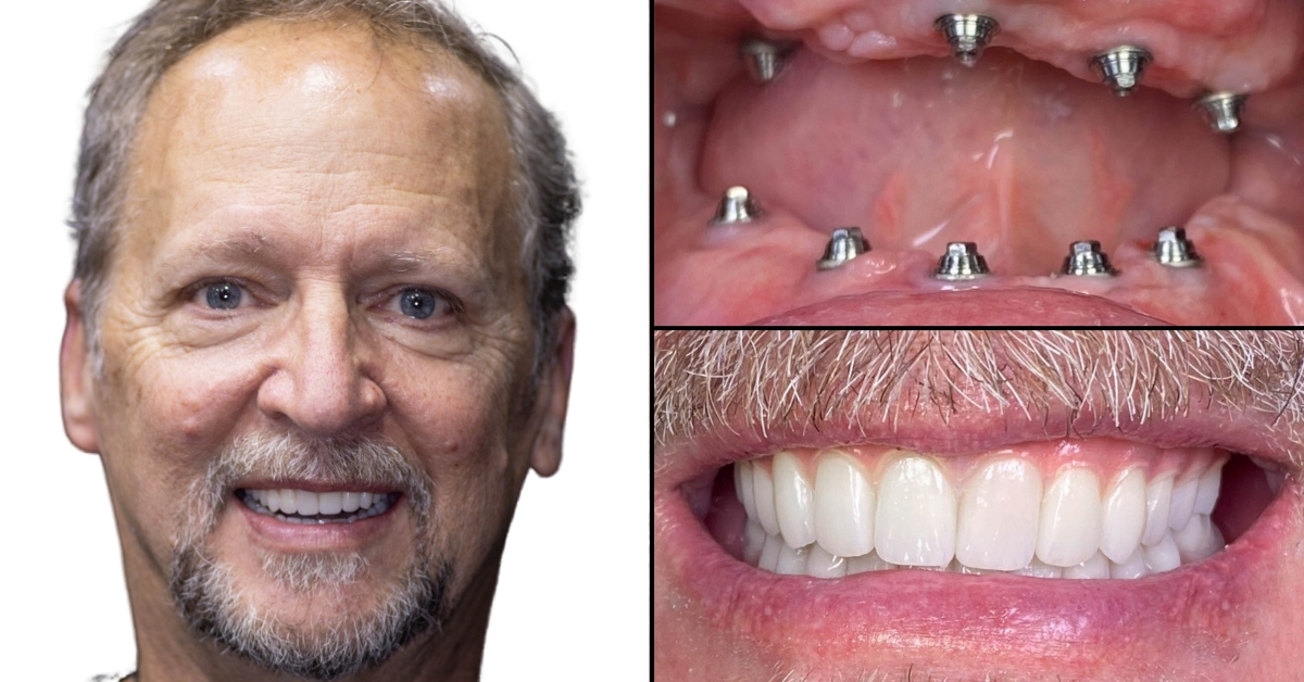 Low-Cost Dental Implants in Mexico