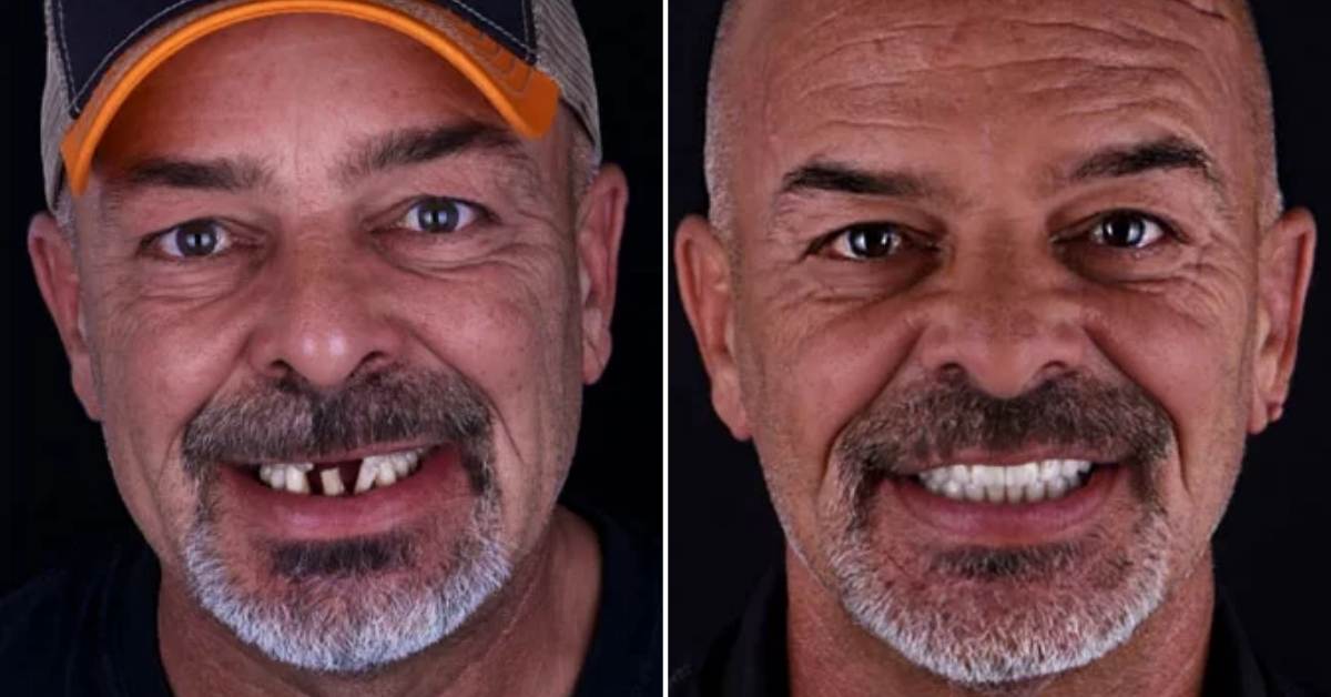 Full Mouth Restoration in Cancun – Mexico