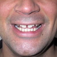 Gaps-in-Teeth