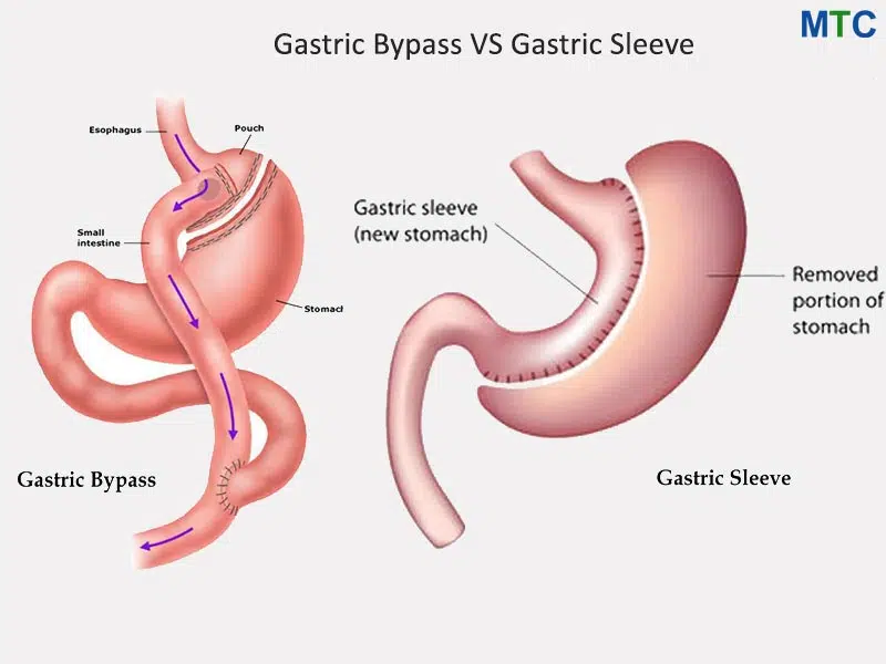 Gastric Bypass vs Sleeve