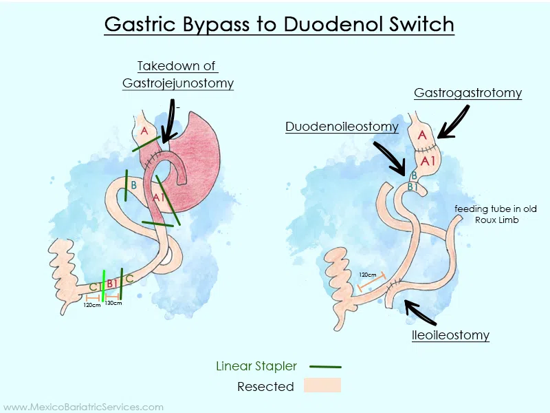 Gastric Bypass to Duodenal Switch