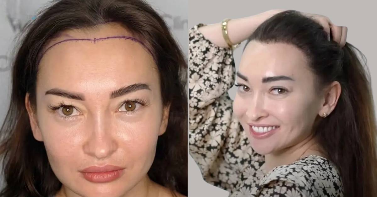 Hair Transplant for Women in Turkey