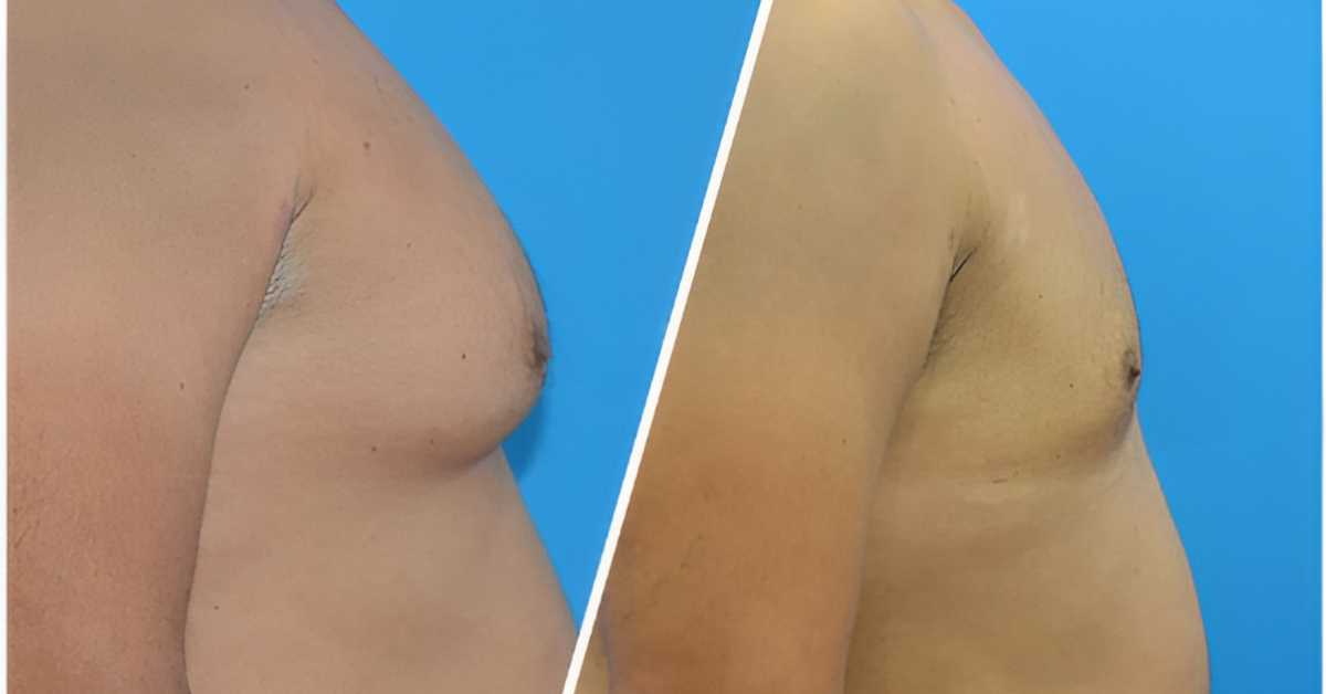 Male Breast Reduction in Mexico