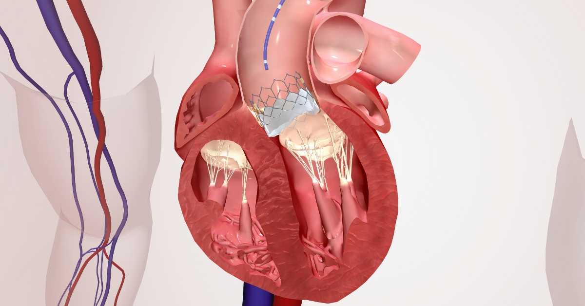 Mitral Valve Repair in Abroad