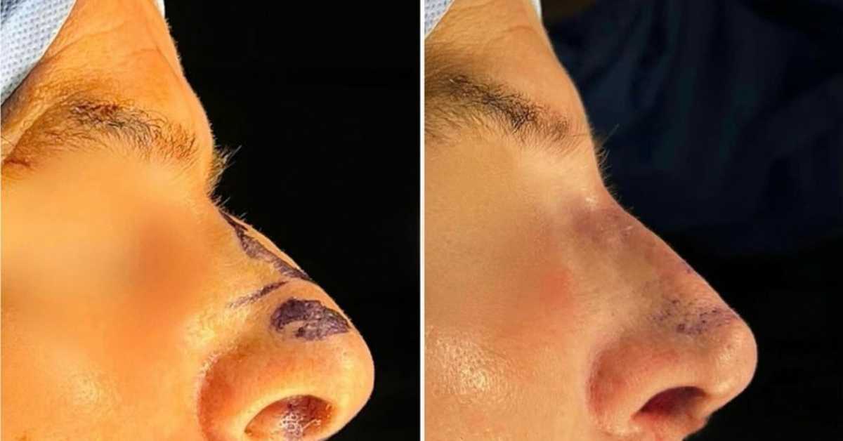 Nose Job in Costa Rica