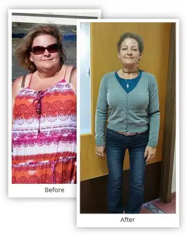 Roberta-Bariatric-Surgery-Mexico-Before-After