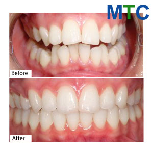 Teeth Whitening in Vietnam Before and After