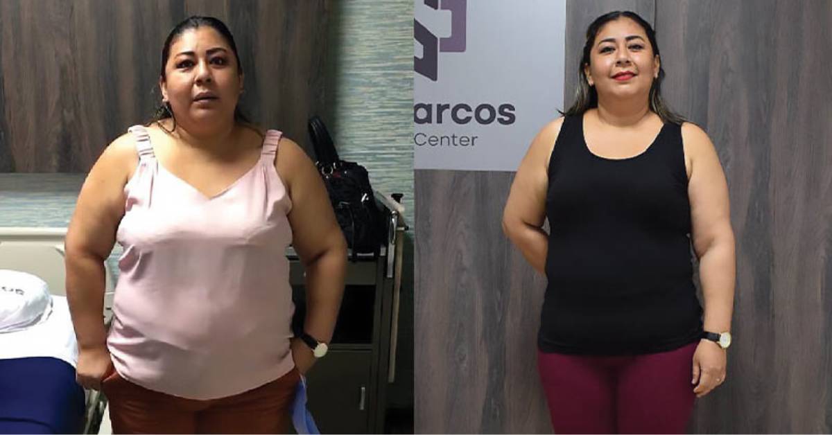 Tackle Obesity With Bariatric Surgery in Ecuador