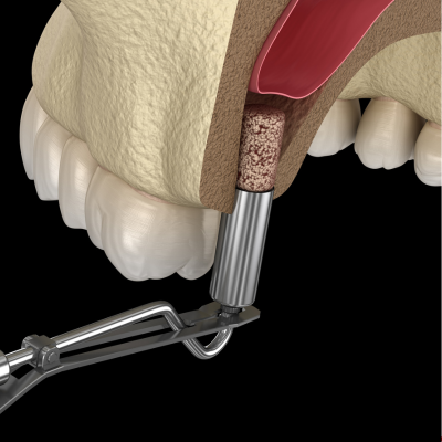 Bone Grafting