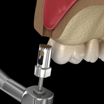 Sinus Lift