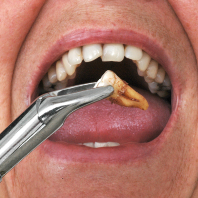 Teeth Extraction