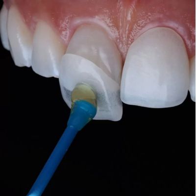 Close-up of a porcelain veneer being bonded to a tooth with adhesive, showcasing the precise application process.