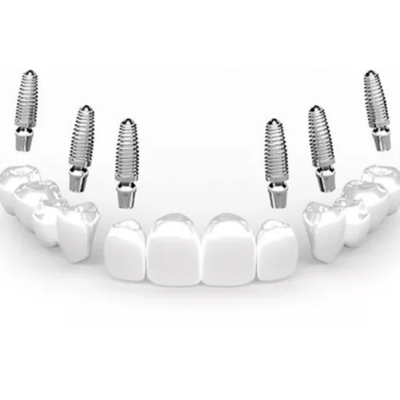 3 on 6 dental implants