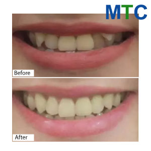 Vietnam Dental Veneers Before and After