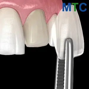 Zirconia Veneers