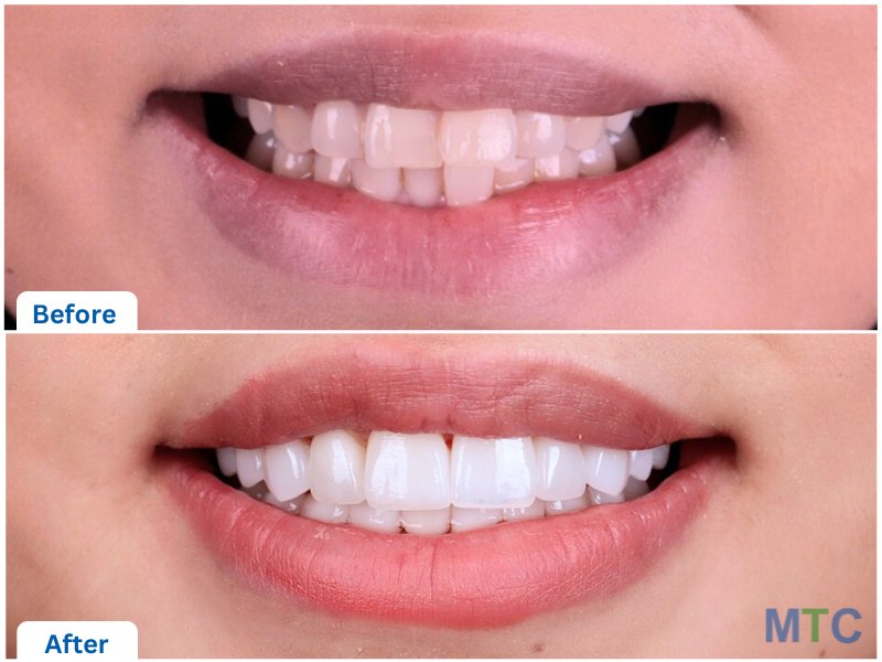 before & after veneers, istanbul