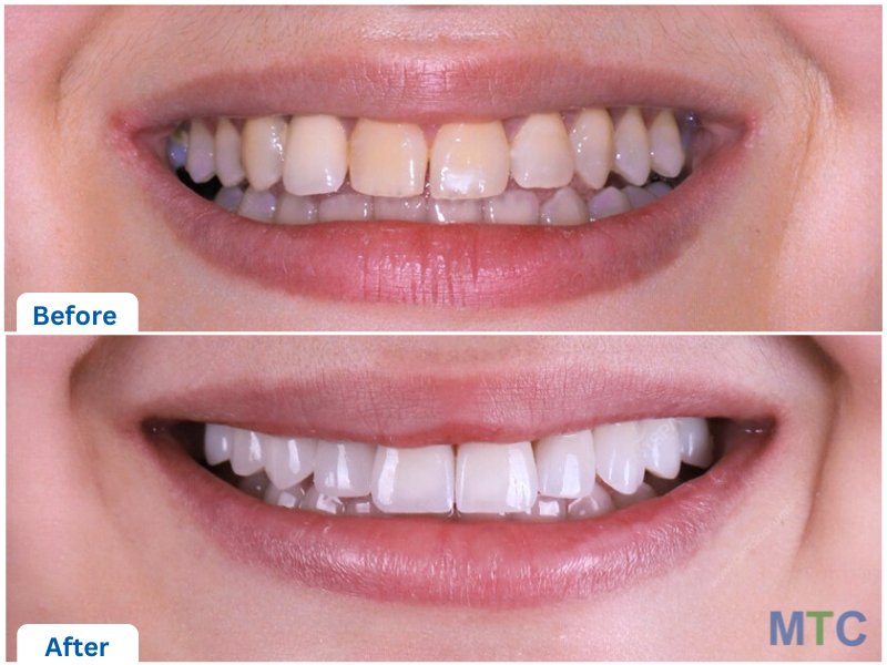 before & after veneers, istanbul