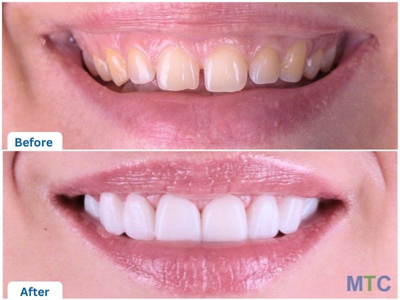 before &after veneers, istanbul