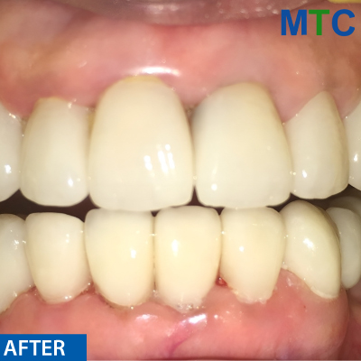 After Root Canal Treatment Followed by Crown - Case#2