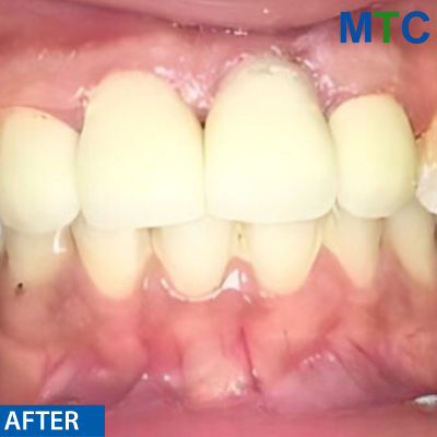 After Root Canal Treatment Followed by Crown - Case#1