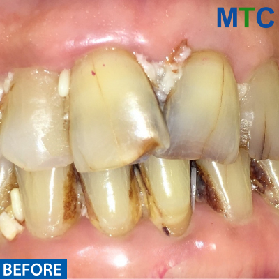 Before Root Canal Treatment - Case#1