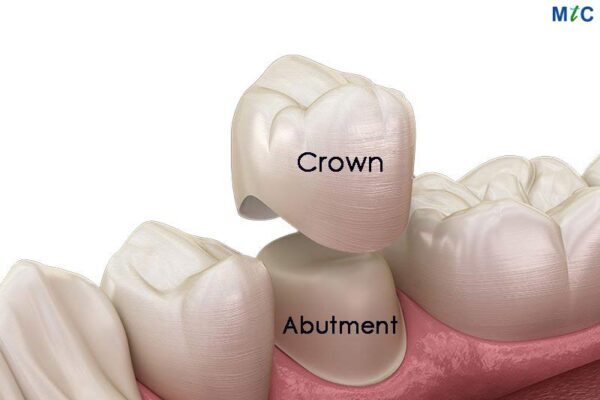 Dental Crowns in Panchkula, Haryana