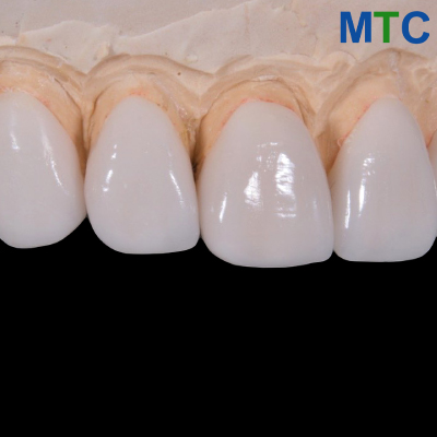 Dental Veneers