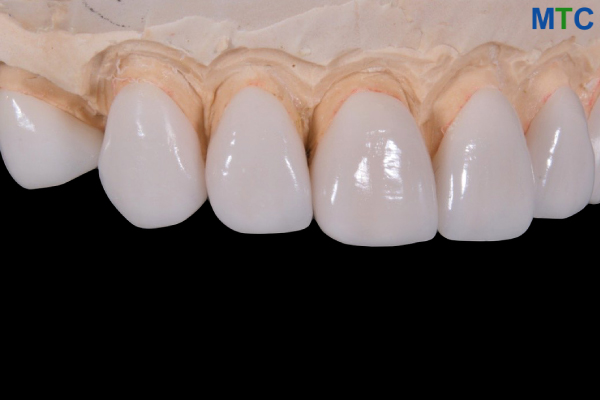 Dental Veneers