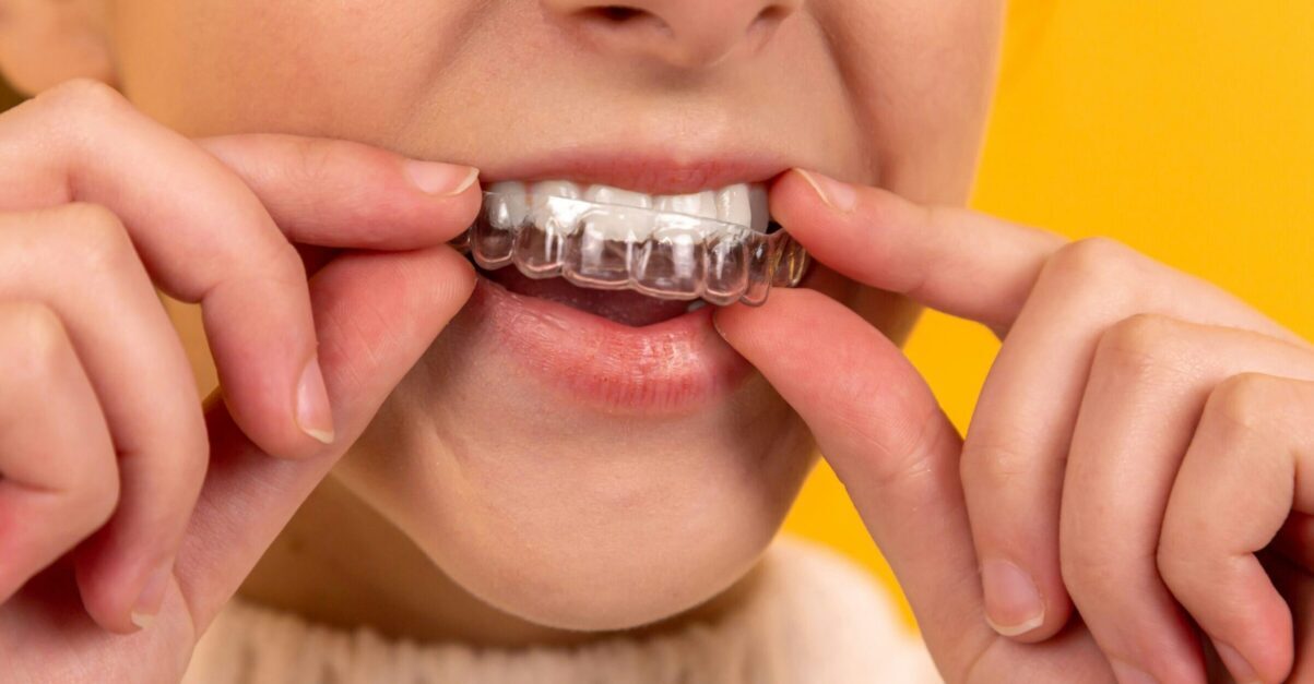 Invisalign in Chandigarh