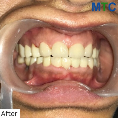 Dental Veneers in Panchkula - After