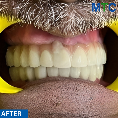 After Dental Implants in Panchkula Case#1