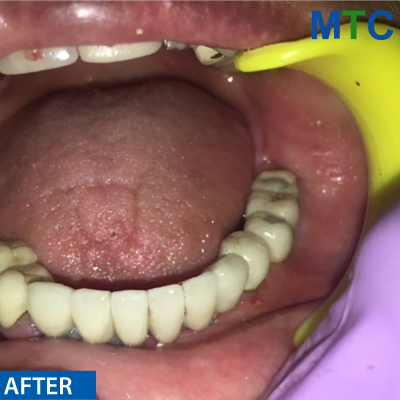 After Dental Implants in Panchkula - Case#2