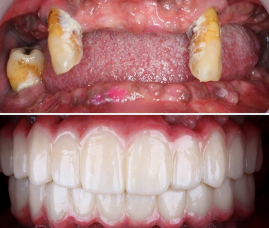 full mouth implants with crowns