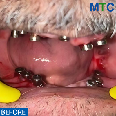 Dental Implants in Panchkula Case#1