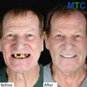 Before-After-Full-Mouth-Implants-in-Los-Algodones