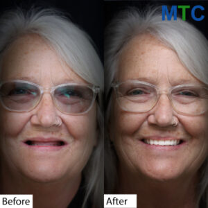 Before-After-Full-Mouth-Implants-in-Los-Algodones