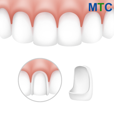 Dental Veneers