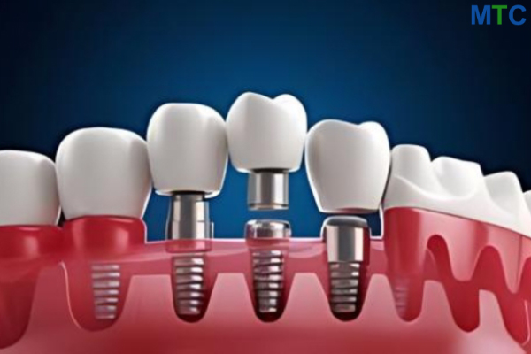 Dental Implants in Panchkula