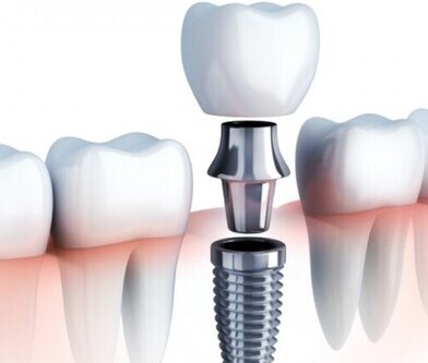 Dental Implant Package