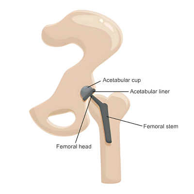 Anatomy of Artificial Hip Joint