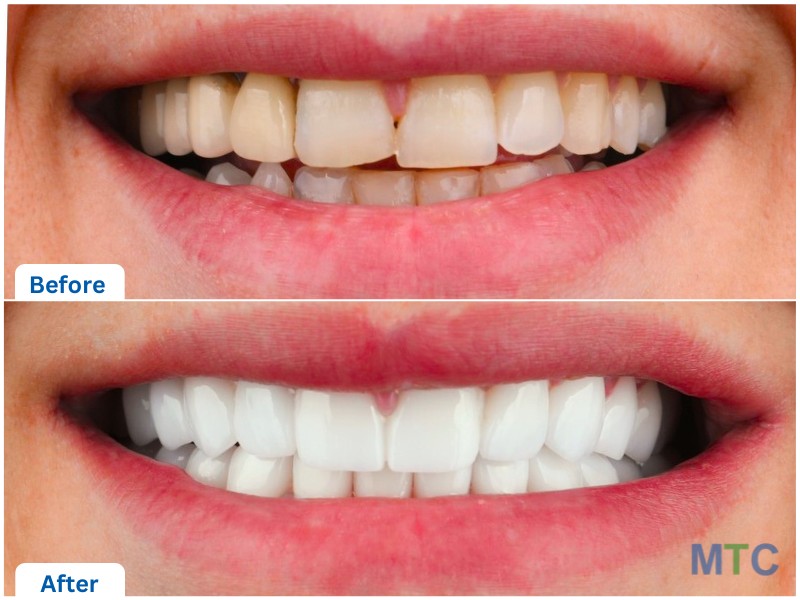 E-max Veneers