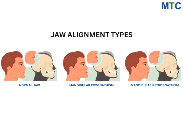 Jaw Alignment Types | Orthognathic Surgery