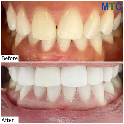 Before & After Zygomatic Dental Implants in Mexico 5