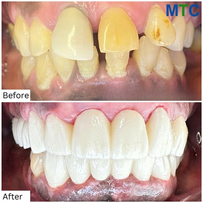 Before & After Zirconia Crowns in Tijuana