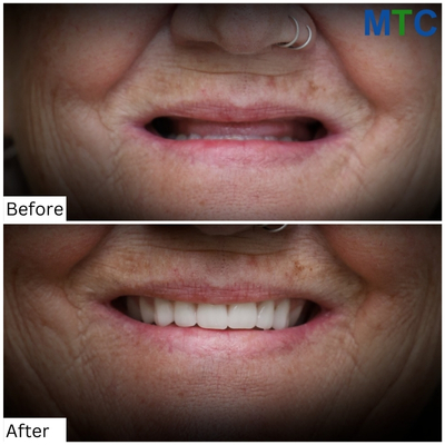 Before & After Zygomatic Dental Implants in Mexico 2