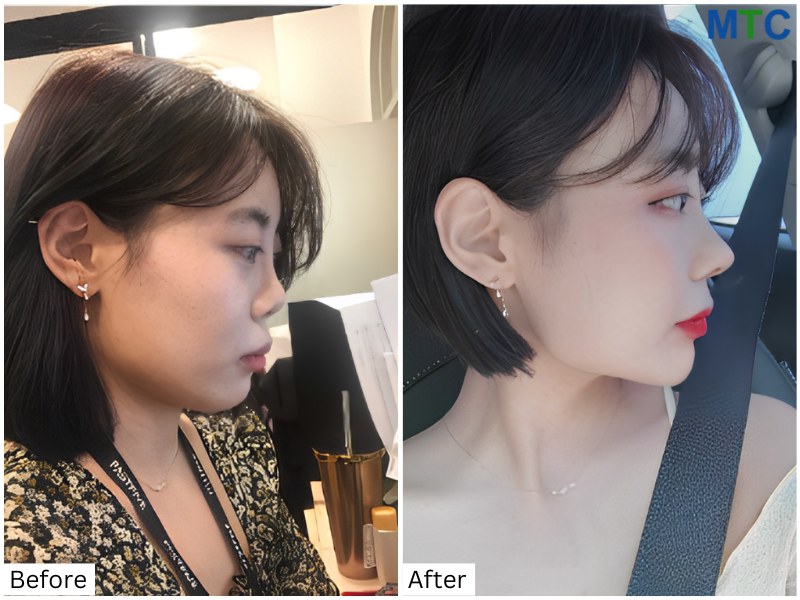 Rhinoplasty in Seoul, Korea