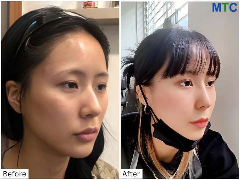 Rhinoplasty in Seoul, Korea